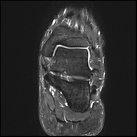 Haglund Syndrome | Radiology Case | Radiopaedia.org