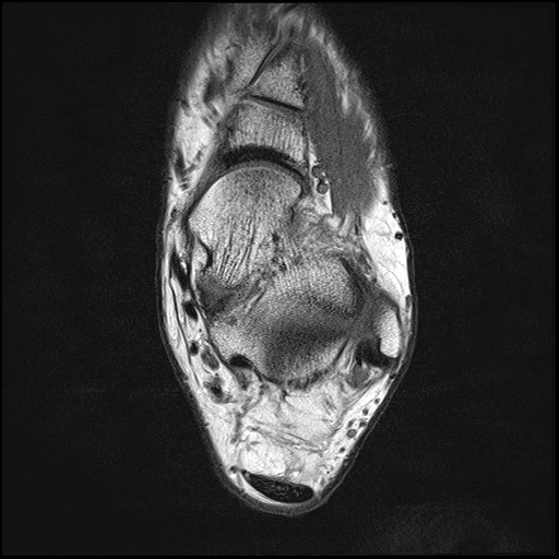 Haglund Syndrome | Image | Radiopaedia.org