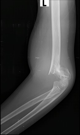 Gartland classification of supracondylar humeral fractures | Radiology ...