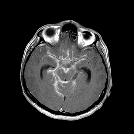 Tuberculous meningitis | Image | Radiopaedia.org