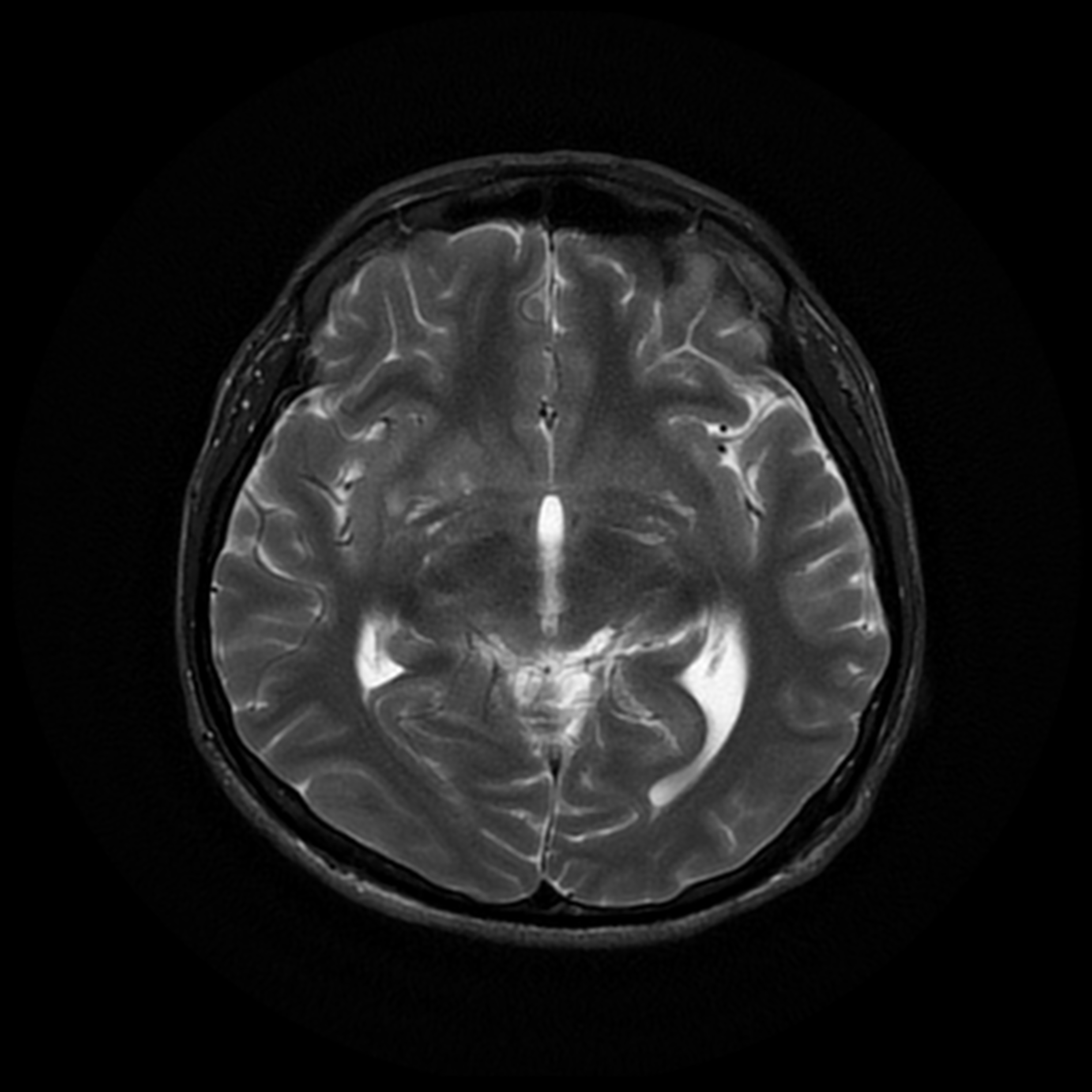 Tuberculous Meningitis | Image | Radiopaedia.org