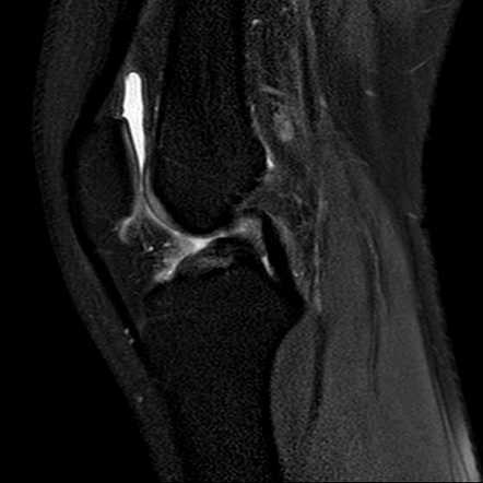 Double PCL sign | Image | Radiopaedia.org