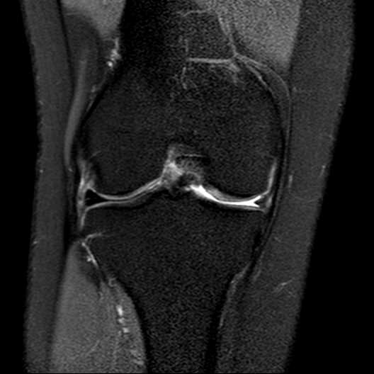 Double PCL sign | Image | Radiopaedia.org