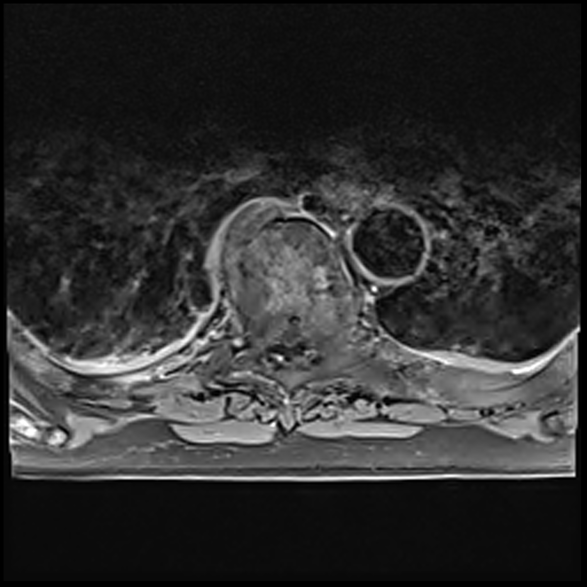 Spinal cord compression from metastatic prostate cancer | Image ...