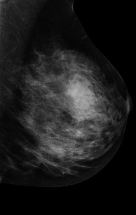 Simple cyst on contrast mammogram | Image | Radiopaedia.org