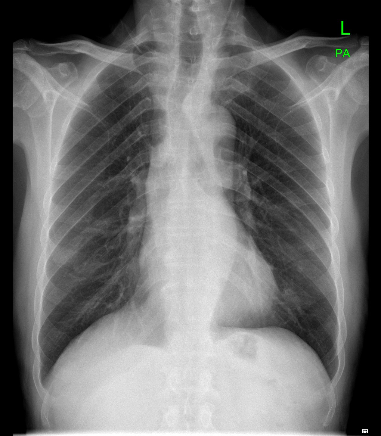 vocal-cord-paralysis-due-to-esophageal-carcinoma-image-radiopaedia