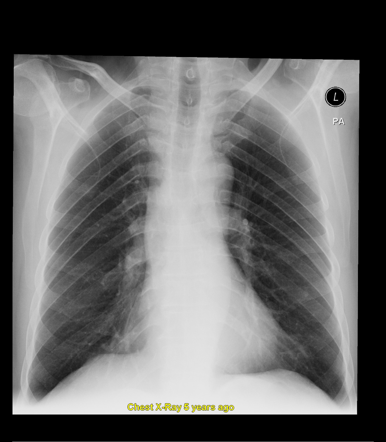 Vocal cord paralysis due to esophageal carcinoma | Image | Radiopaedia.org