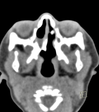 Unilateral choanal atresia | Radiology Case | Radiopaedia.org