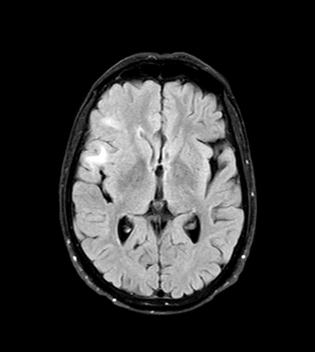 Cerebral metastasis mimicking an abscess | Image | Radiopaedia.org