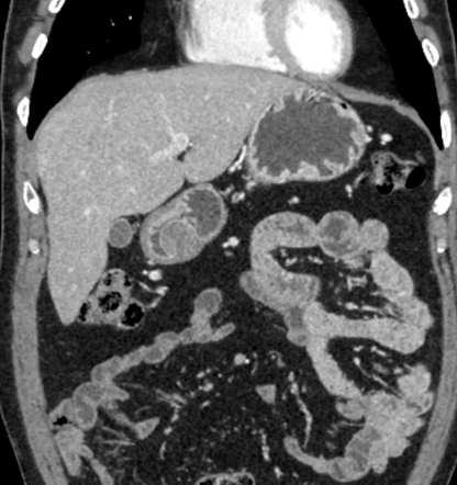 Gastrointestinal stromal tumor - stomach | Radiology Case | Radiopaedia.org