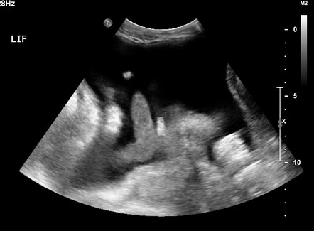 Ascites | Radiology Reference Article | Radiopaedia.org