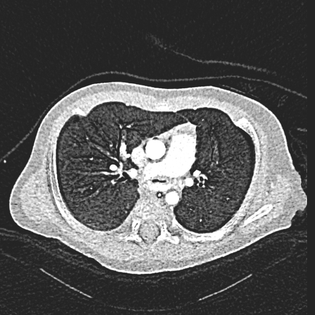 Left pulmonary artery sling | Image | Radiopaedia.org