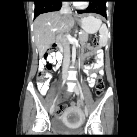 Immature teratoma | Image | Radiopaedia.org