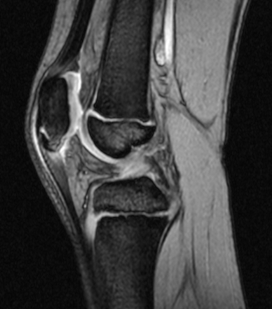 Jumper's knee | Image | Radiopaedia.org