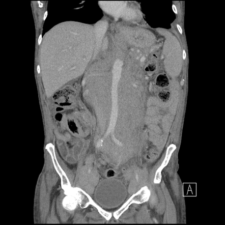 Diffuse mantle cell lymphoma | Image | Radiopaedia.org