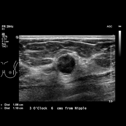 Breast metastases from renal cell cancer | Radiology Case | Radiopaedia.org