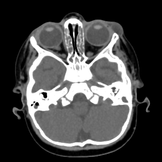 External angular dermoid cyst | Image | Radiopaedia.org