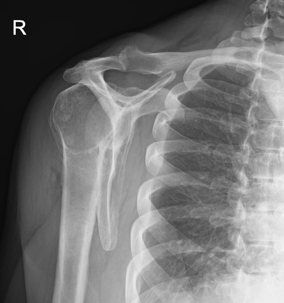 Shoulder osteoarthritis - inferior osteophyte | Image | Radiopaedia.org