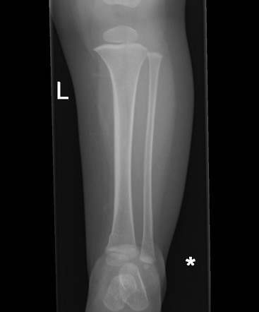 Buckle fracture - tibia | Radiology Case | Radiopaedia.org