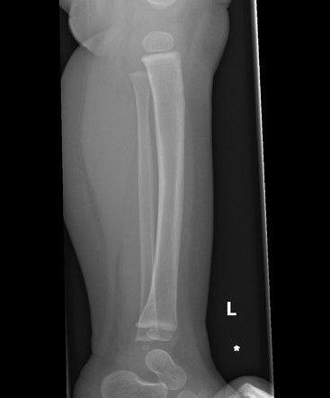 Buckle fracture - tibia | Image | Radiopaedia.org