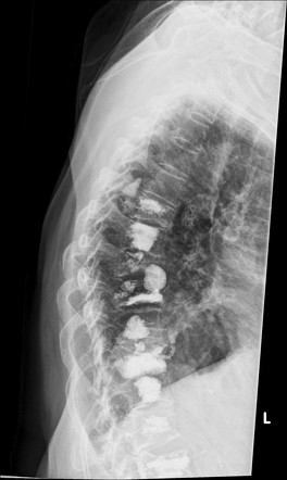 sclerotic metastases radiopaedia vertebroplasty differential radiology