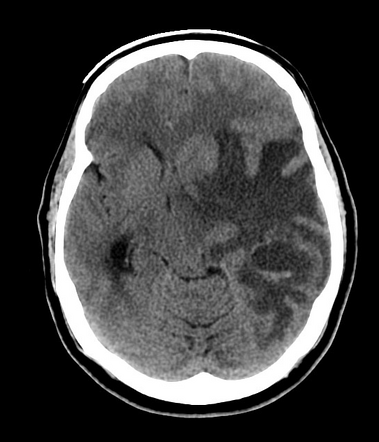 Metastatic adenocarcinoma of the lung | Radiology Case | Radiopaedia.org