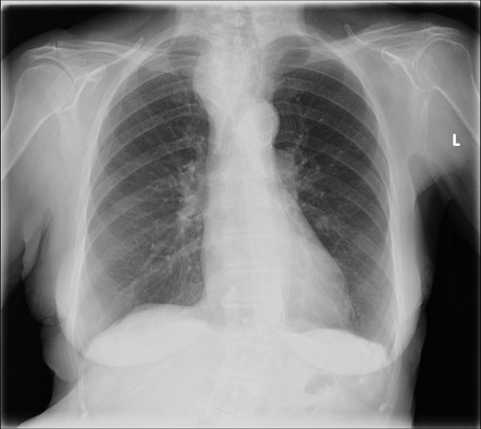 Goiter | Radiology Case | Radiopaedia.org