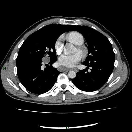 Sarcoidosis | Image | Radiopaedia.org