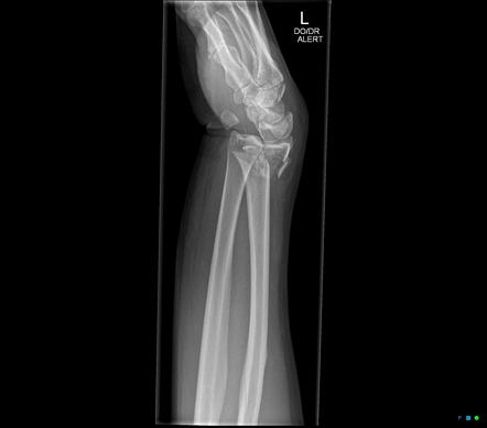 Dislocated pisiform associated with distal radial fracture | Image ...