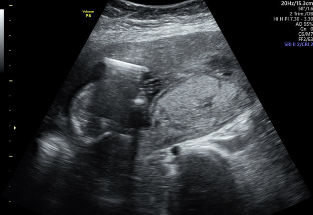 Lung Ultrasound Comet Tails — Technique and Clinical Significance |  IntechOpen