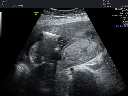 Reverberation artifact | Radiology Reference Article | Radiopaedia.org