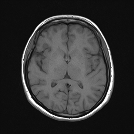 Left MCA acute ischemic stroke | Image | Radiopaedia.org