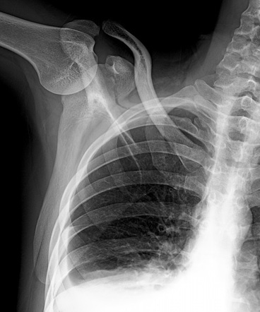 Coracoid process fracture | Radiology Reference Article | Radiopaedia.org