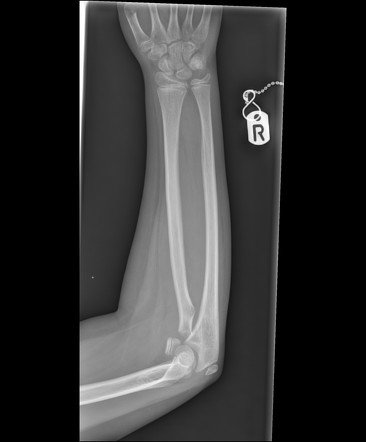 displaced radial neck fracture icd 10