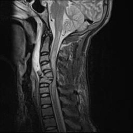 Flexion teardrop fracture | Image | Radiopaedia.org