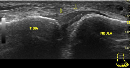 Anterior Inferior Tibiofibular Ligament Radiology Reference Article Radiopaedia Org