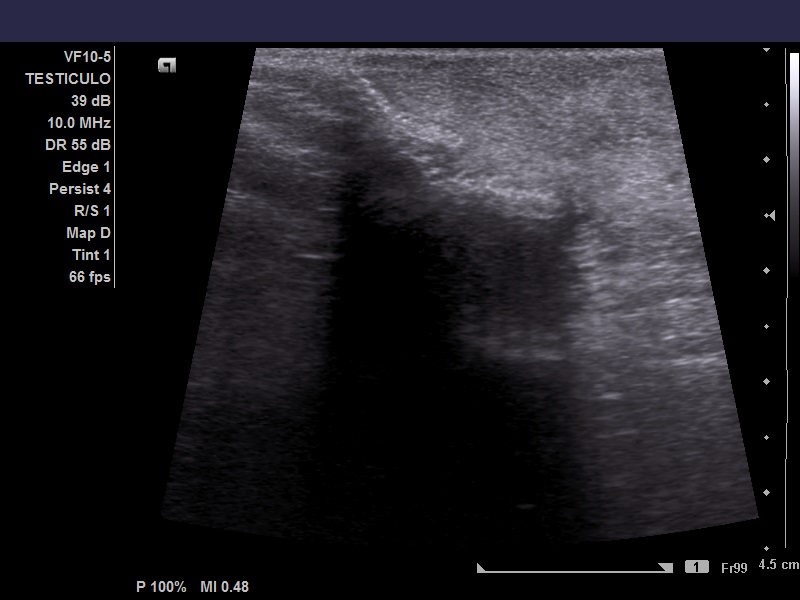 Testicular Abscess And Pyocele Image 4330