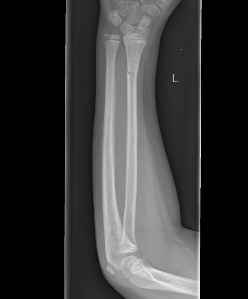 greenstick fracture humerus