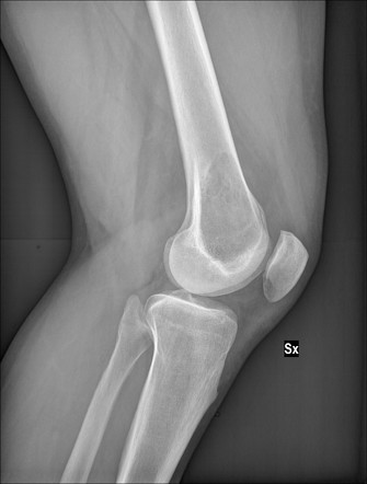 Giant cell tumor sarcomatous degeneration with pathological fracture ...