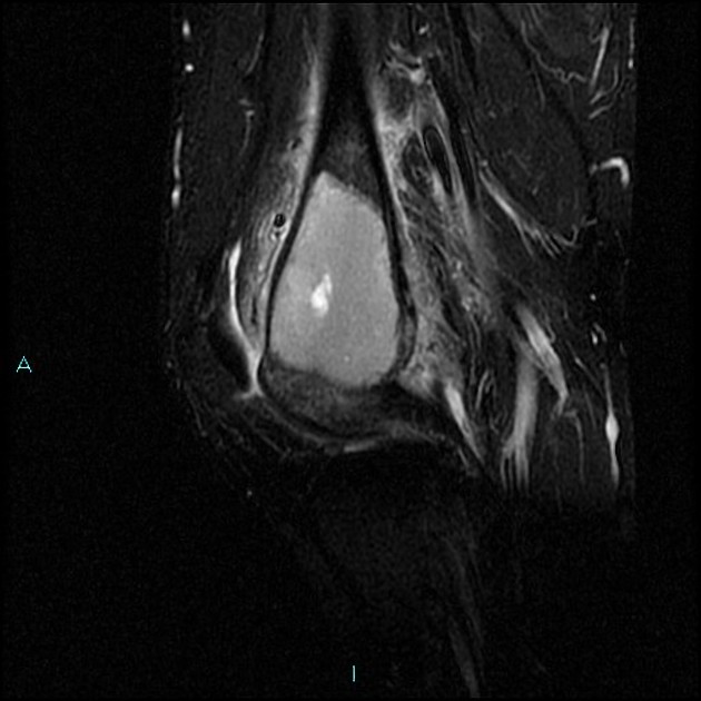 Giant cell tumor sarcomatous degeneration with pathological 