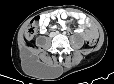 Soft tissue abscess | Radiology Reference Article | Radiopaedia.org