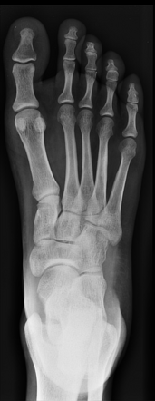 Soft tissue hemangioma - foot | Radiology Case | Radiopaedia.org