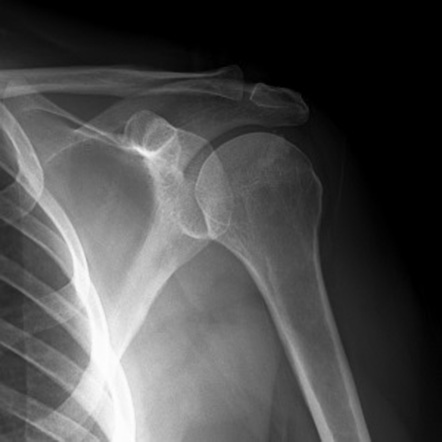 Calcific tendinitis - supraspinatus tendon | Image | Radiopaedia.org