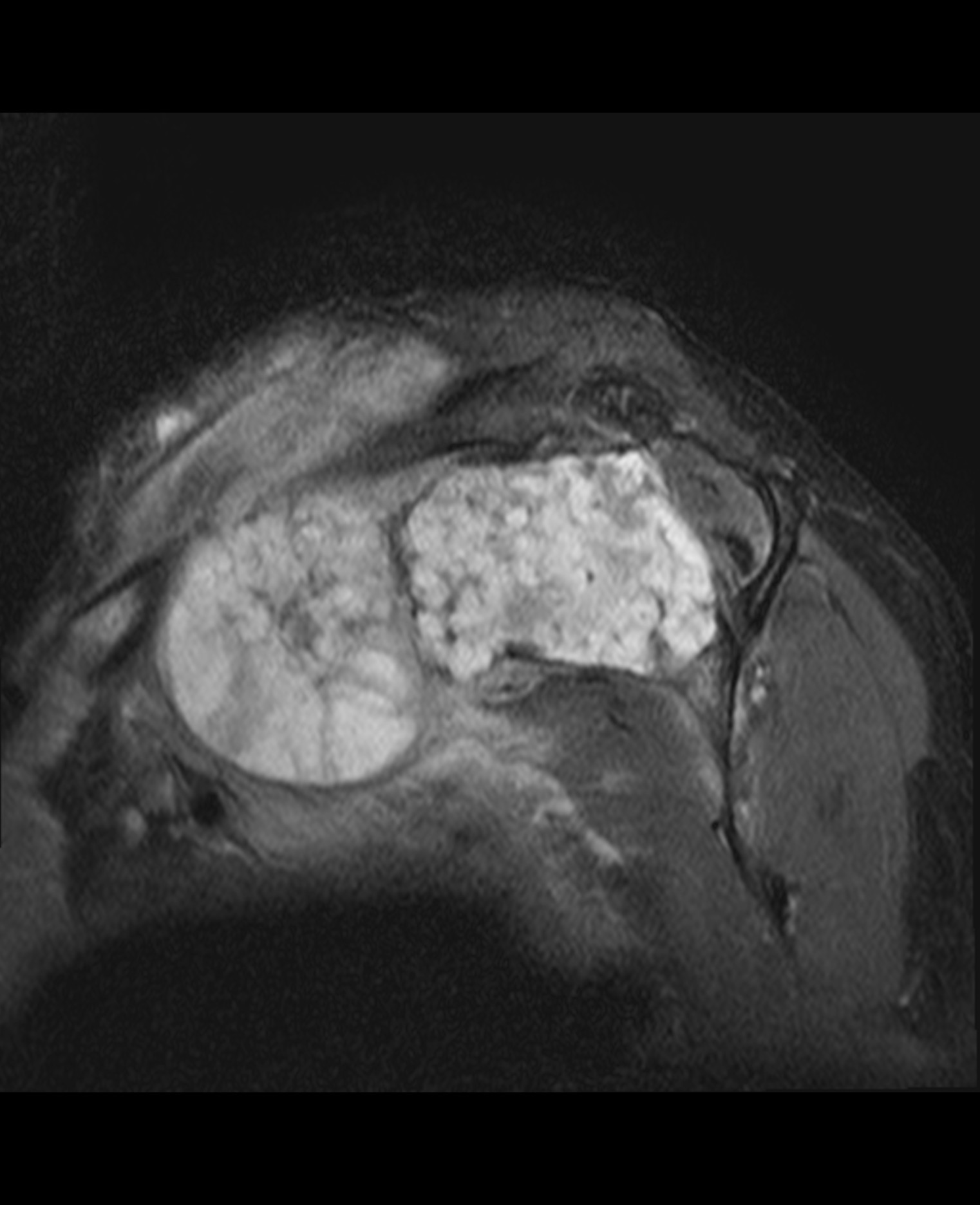 Chondrosarcoma | Image | Radiopaedia.org