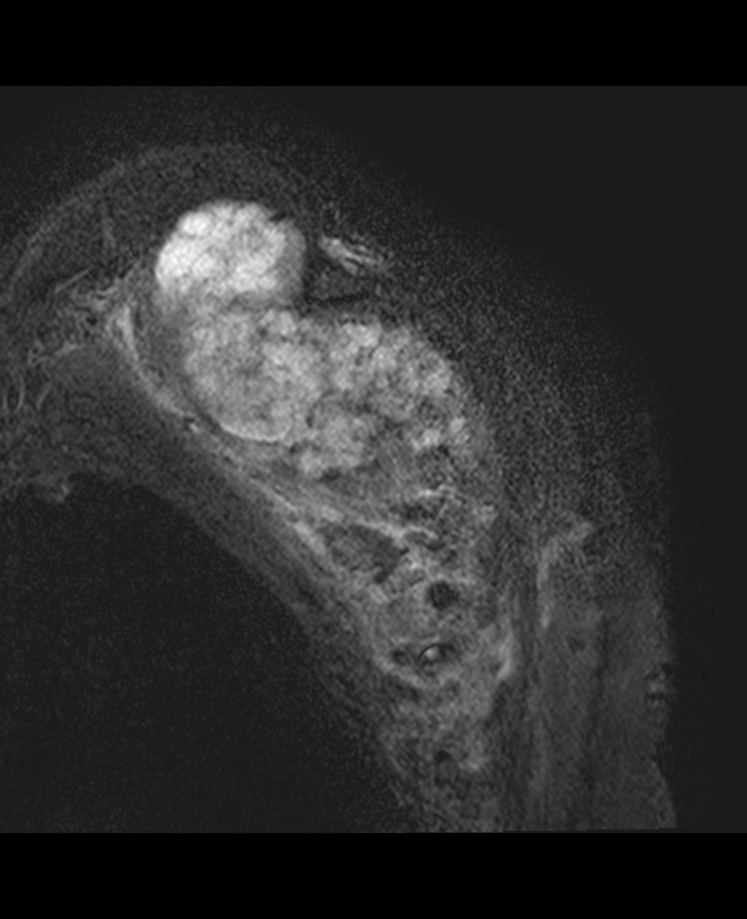 Chondrosarcoma | Image | Radiopaedia.org