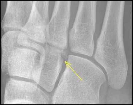 Lateral cuneiform fracture | Image | Radiopaedia.org