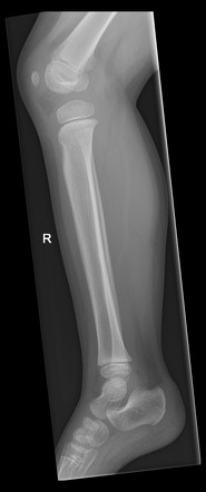 Trampoline fracture | Image | Radiopaedia.org