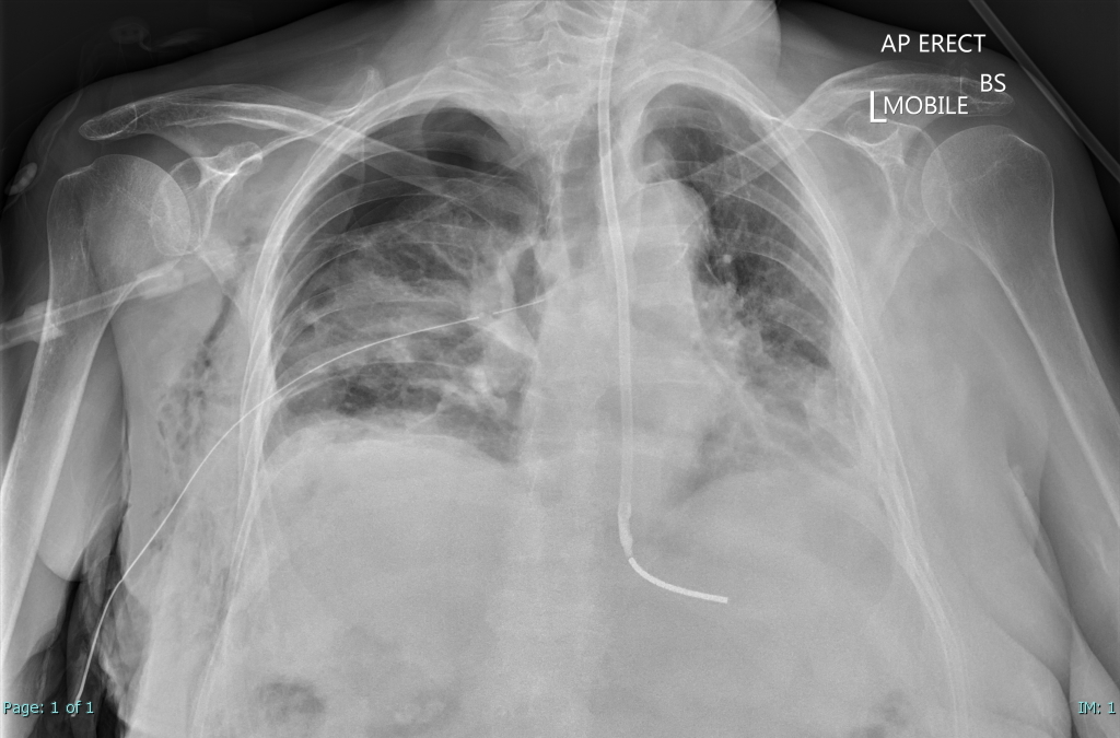 Normal Frontal Chest X Ray Image Radiopaedia Org Vrogue Co