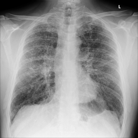 Sarcoidosis | Radiology Case | Radiopaedia.org