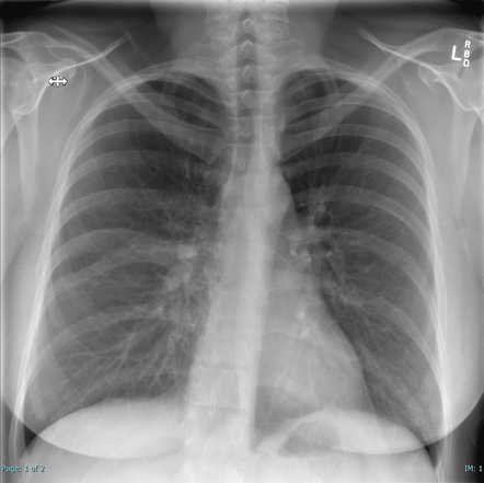 8th and 9th rib convergance | Radiology Case | Radiopaedia.org